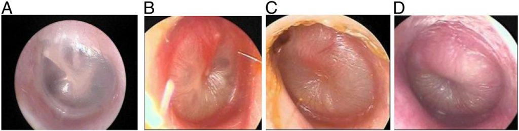 Acute Otitis Media Vs Otitis Media With Effusion