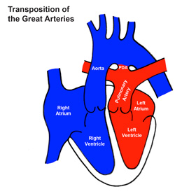 Congenital Heart Diseases – Department of Pediatrics – UW–Madison